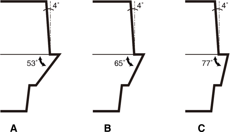 Effect of abutment neck taper and cement types on the amount of remnant cement in cement-retained implant restorations: an <i>in vitro</i> study.