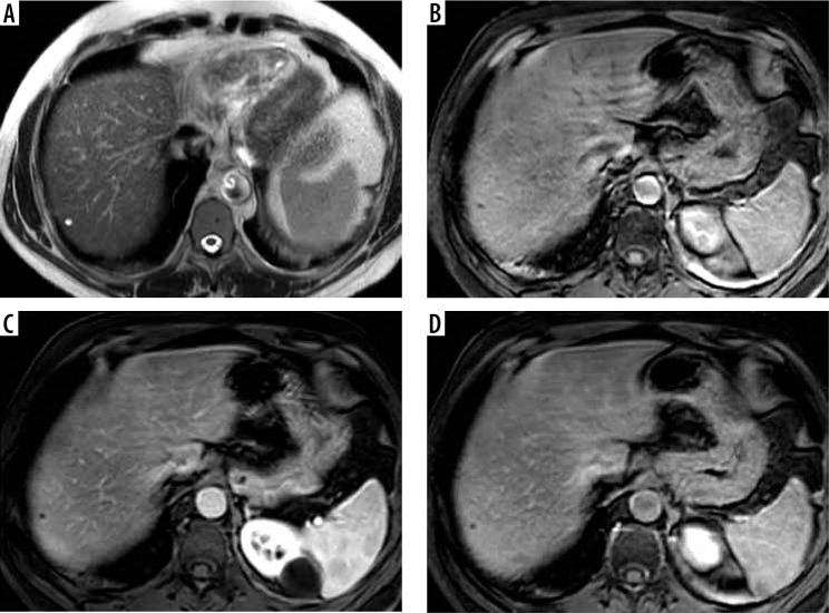 Interrater reliability and agreement of the liver imaging reporting and data system (LI-RADS) v2018 for the evaluation of hepatic lesions.