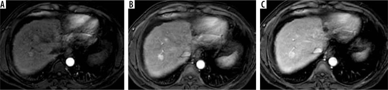 Interrater reliability and agreement of the liver imaging reporting and data system (LI-RADS) v2018 for the evaluation of hepatic lesions.