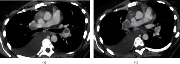 A Rare Case of Metastatic Glioblastoma Diagnosed by Endobronchial Ultrasound-Transbronchial Needle Aspiration.