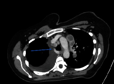 A Rare Case of Metastatic Glioblastoma Diagnosed by Endobronchial Ultrasound-Transbronchial Needle Aspiration.