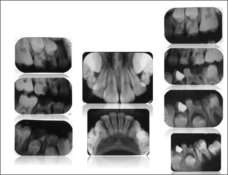 Clinical Management of Molar Incisor Hypomineralization Affected Molars in a Pediatric Patient Including Endodontic Treatment, Case Report and Review of the Literature.