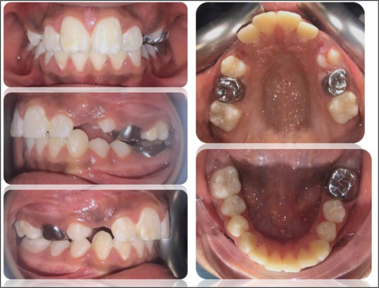 Clinical Management of Molar Incisor Hypomineralization Affected Molars in a Pediatric Patient Including Endodontic Treatment, Case Report and Review of the Literature.