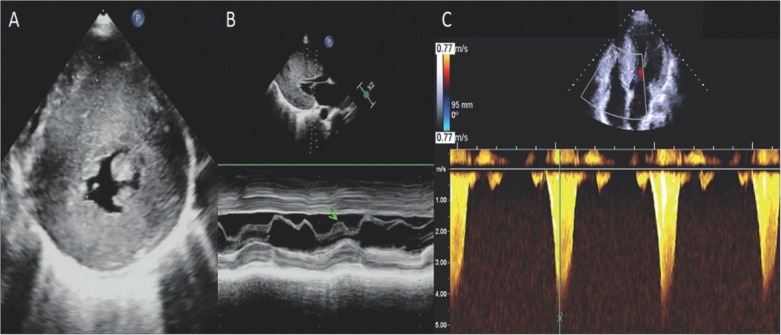 A Novel <i>Loss-of-function</i> Mutation in <i>MYBPC3</i> Causes Familial Hypertrophic Cardiomyopathy with Extreme Intrafamilial Phenotypic Heterogeneity.