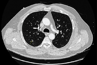 Primary Adenosquamous Carcinoma of the Prostate with Rectal Invasion.