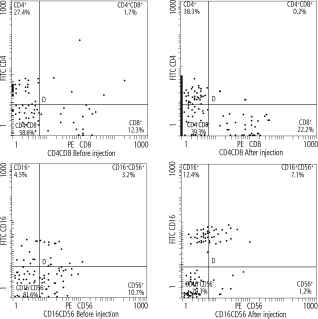 Therapeutic efficacy of dendritic cell injection in advanced hepatocellular carcinoma: the role of natural killer and T lymphocytes.