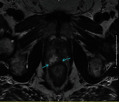 Primary Adenosquamous Carcinoma of the Prostate with Rectal Invasion.