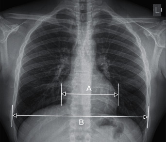 Radiological Cardiothoracic Ratio as a Potential Marker of Left Ventricular Hypertrophy Assessed by Echocardiography.