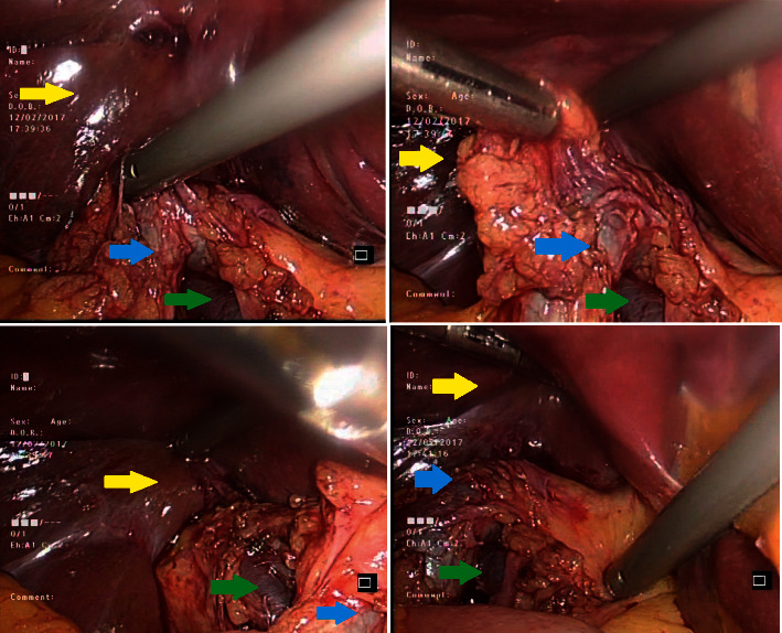 Gallbladder Agenesis without Additional Biliary Tracts Abnormality.