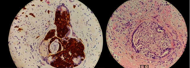 Primary Adenosquamous Carcinoma of the Prostate with Rectal Invasion.