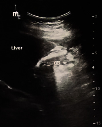 Gallbladder Agenesis without Additional Biliary Tracts Abnormality.