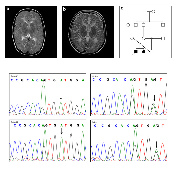 A novel mutation in GJC2 associated with hypomyelinating leukodystrophy type 2 disorder.