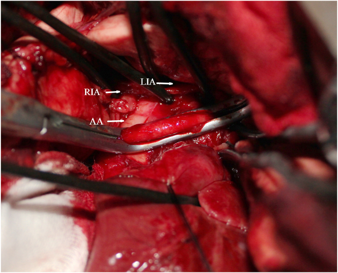 A canine model of aortic arch aneurysm created with autologous pericardium