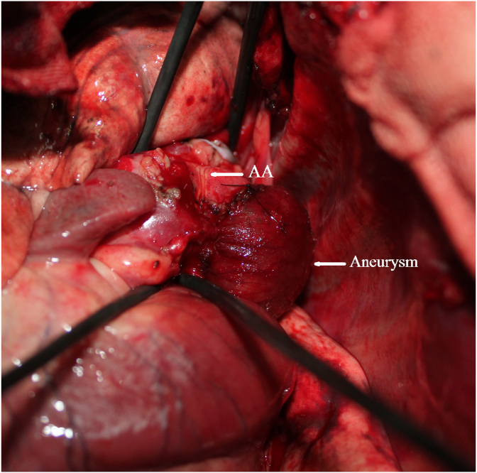 A canine model of aortic arch aneurysm created with autologous pericardium