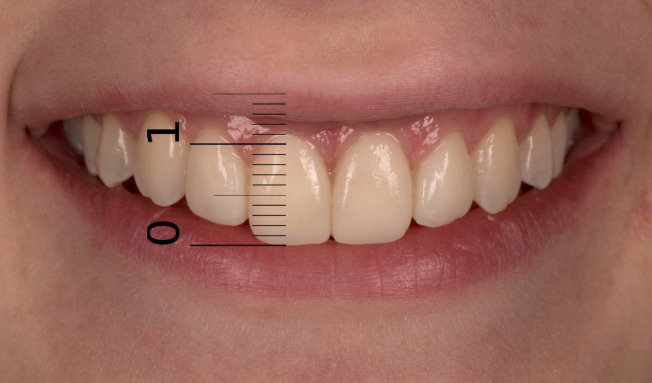 Impact of Gingival Margin Asymmetries on the Smile Esthetic Perception of Dental Specialists, Doctors of Dental Medicine, Students, and Laypeople: a Comparative Pilot Study.