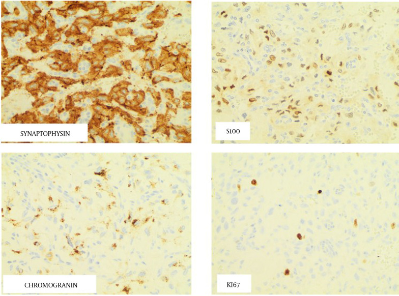 RET T244I Germline Variant Mutation in a Patient with Pancreatic Paraganglioma and Primary Hyperparathyroidism.