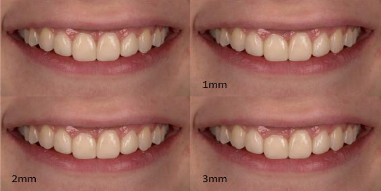 Impact of Gingival Margin Asymmetries on the Smile Esthetic Perception of Dental Specialists, Doctors of Dental Medicine, Students, and Laypeople: a Comparative Pilot Study.