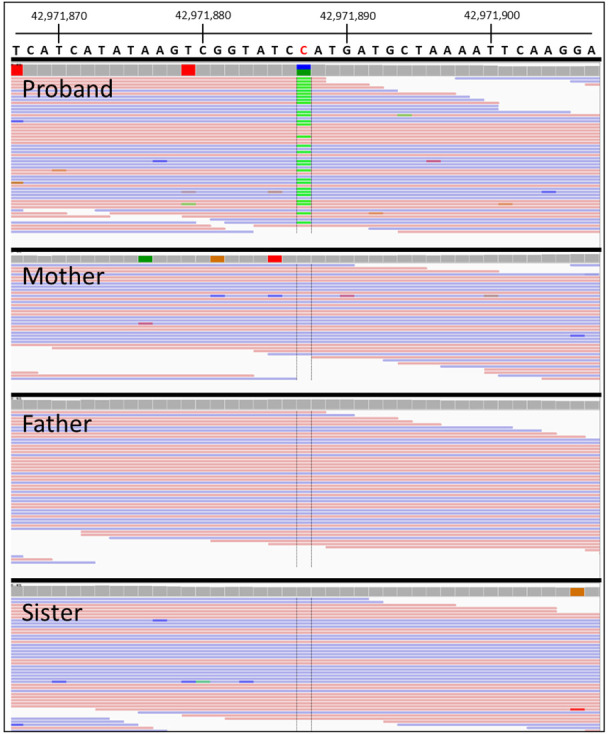 A de novo start-loss in <i>EFTUD2</i> associated with mandibulofacial dysostosis with microcephaly: case report.