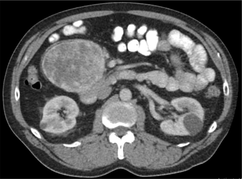 RET T244I Germline Variant Mutation in a Patient with Pancreatic Paraganglioma and Primary Hyperparathyroidism.