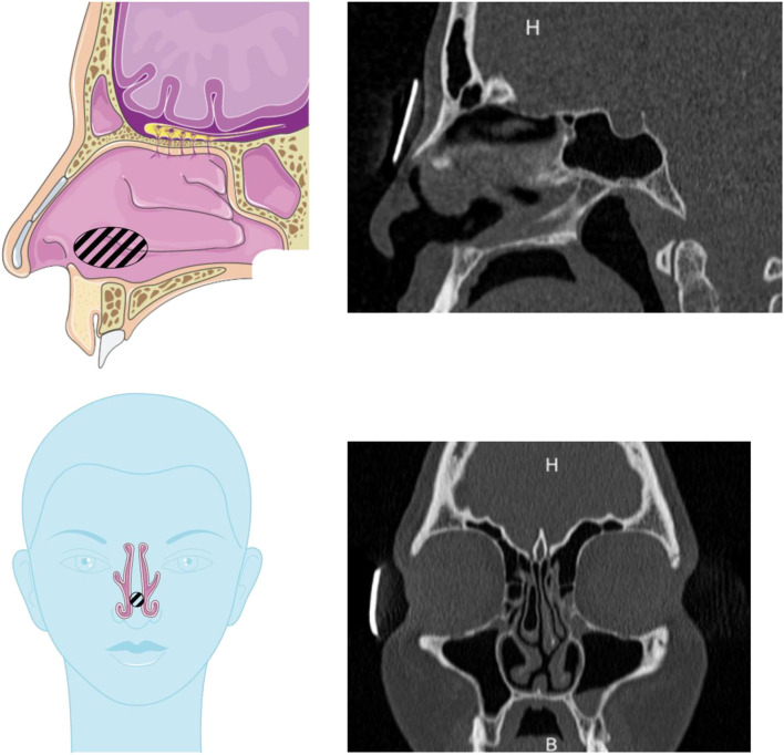 Instillation of a Dry Powder in Nasal Casts: Parameters Influencing the Olfactory Deposition With Uni- and Bi-Directional Devices.