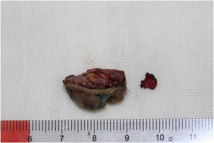 Eyelid squamous cell carcinoma in the setting of epidermodysplasia verruciformis (EV) diagnosed by next-generation sequencing: A case report and literature review