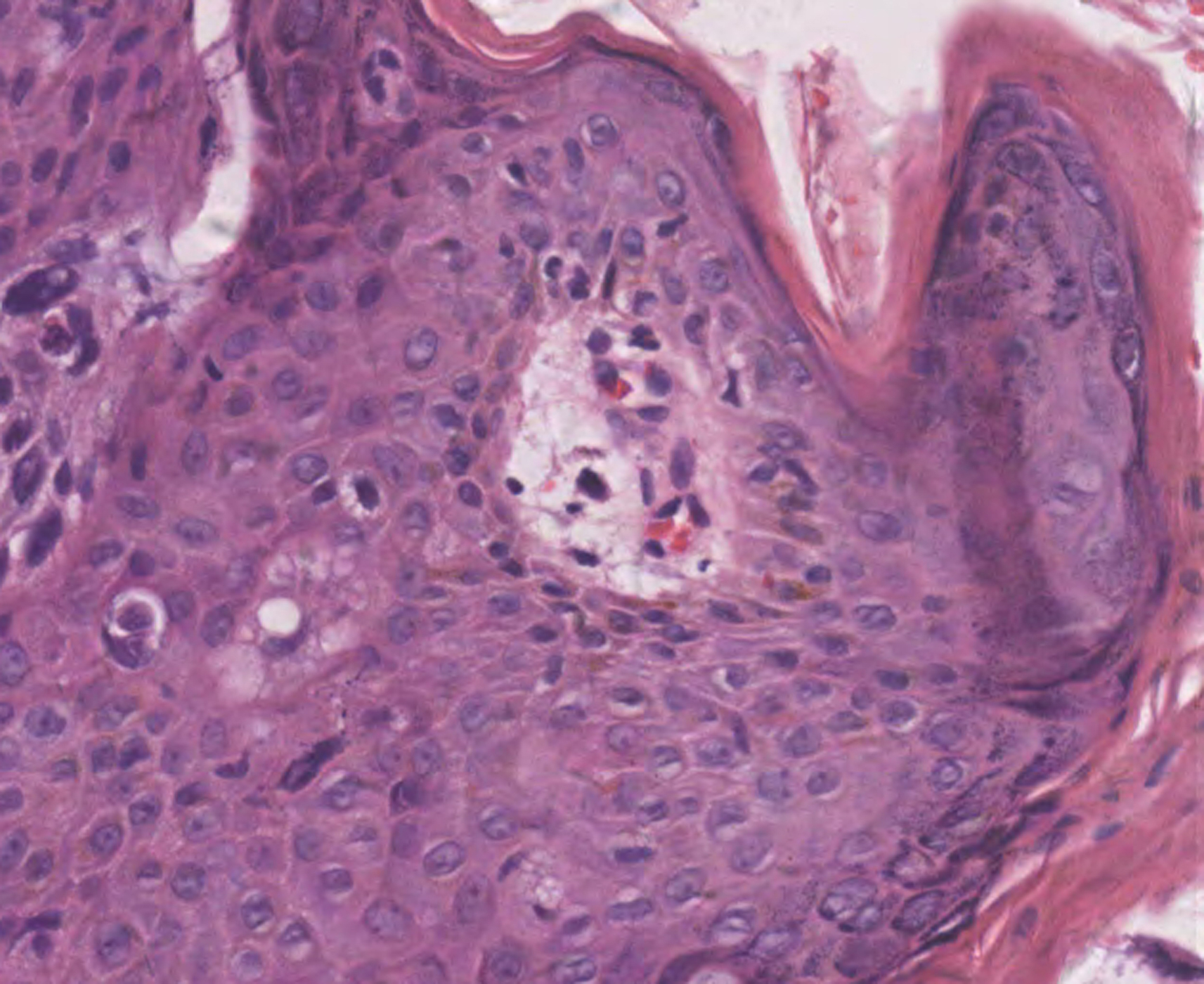 Eyelid squamous cell carcinoma in the setting of epidermodysplasia verruciformis (EV) diagnosed by next-generation sequencing: A case report and literature review