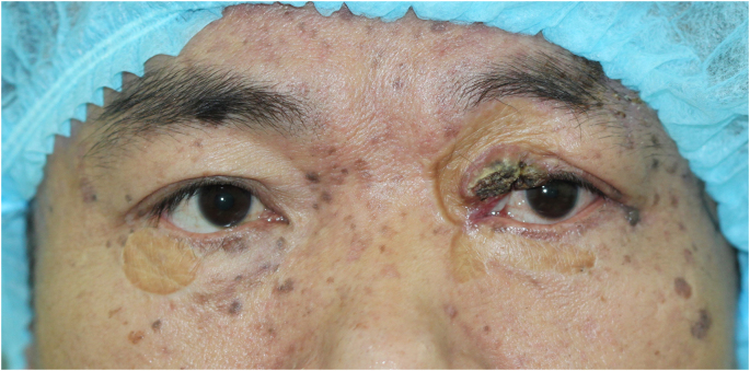 Eyelid squamous cell carcinoma in the setting of epidermodysplasia verruciformis (EV) diagnosed by next-generation sequencing: A case report and literature review