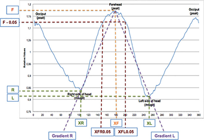 Intracranial Volume Not Correlated With Severity in Trigonocephaly.