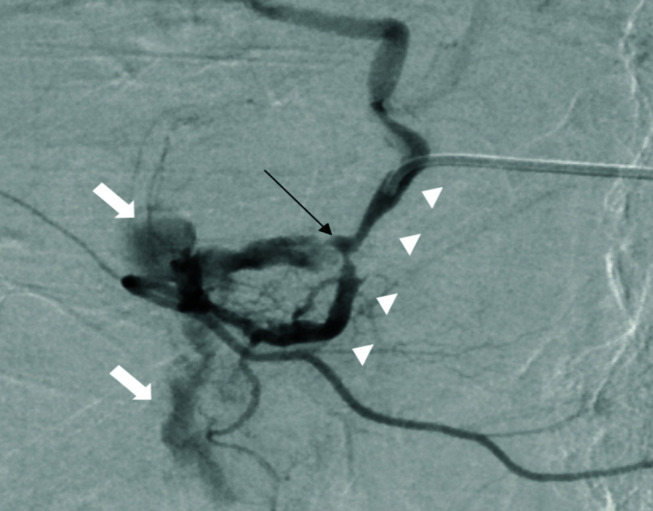 Gastroduodenal artery embolization for peptic ulcer hemorrhage refractory to endoscopic intervention: A single-center experience.