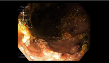 Protein Loss Enteropathy as an Initial Presentation of Gastric Epstein-Barr Virus Lymphoma.