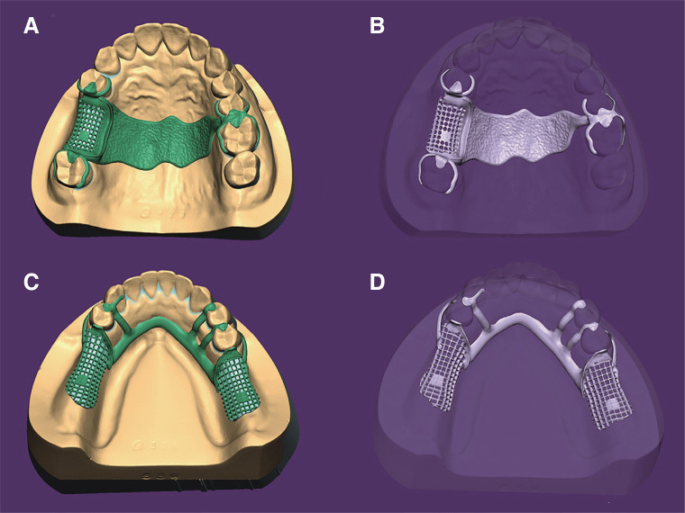 Trueness of 3D printed partial denture frameworks: build orientations and support structure density parameters.