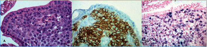 Protein Loss Enteropathy as an Initial Presentation of Gastric Epstein-Barr Virus Lymphoma.