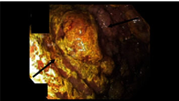 Protein Loss Enteropathy as an Initial Presentation of Gastric Epstein-Barr Virus Lymphoma.
