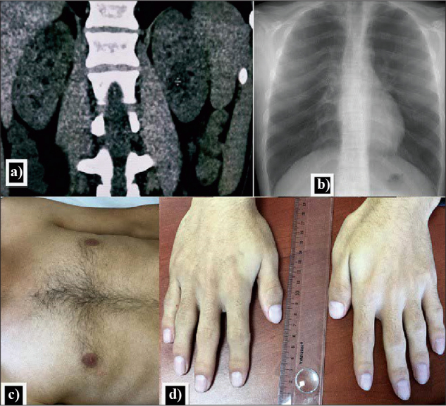 Having Multiple Renal Cysts in a Young Adult is not Always a Sign of Polycystic Kidney Disease.