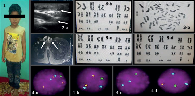 48,XYYY: A Rare Case Report.