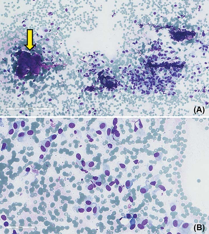 Low-Grade Fibromyxoid Sarcoma Featuring an Unusual <i>EWSR1-CREB3L2</i> Gene Fusion: Report of a Rare Case Arising in the Parotid Gland.