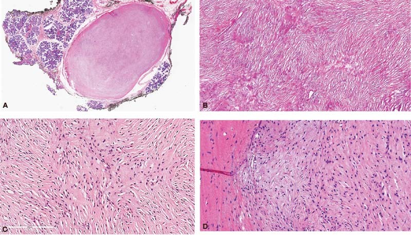 Low-Grade Fibromyxoid Sarcoma Featuring an Unusual <i>EWSR1-CREB3L2</i> Gene Fusion: Report of a Rare Case Arising in the Parotid Gland.