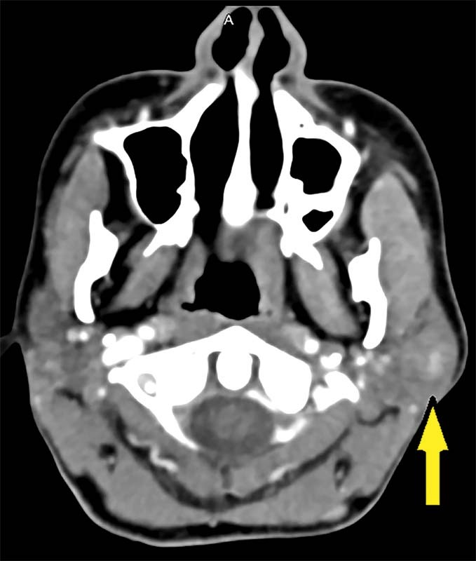 Low-Grade Fibromyxoid Sarcoma Featuring an Unusual <i>EWSR1-CREB3L2</i> Gene Fusion: Report of a Rare Case Arising in the Parotid Gland.