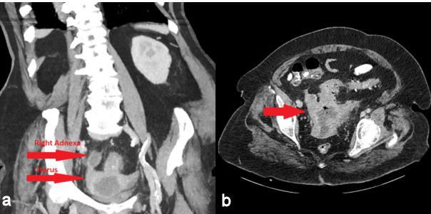 Idiopathic pyometra and tubo-ovarian abscess in a postmenopausal patient treated conservatively.