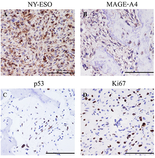 Clinicopathological assessment of cancer/testis antigens NY‑ESO‑1 and MAGE‑A4 in osteosarcoma.