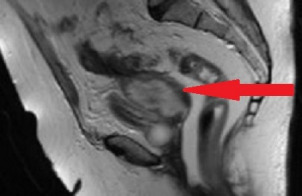 Idiopathic pyometra and tubo-ovarian abscess in a postmenopausal patient treated conservatively.