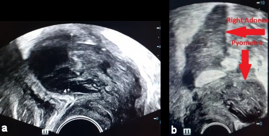 Idiopathic pyometra and tubo-ovarian abscess in a postmenopausal patient treated conservatively.