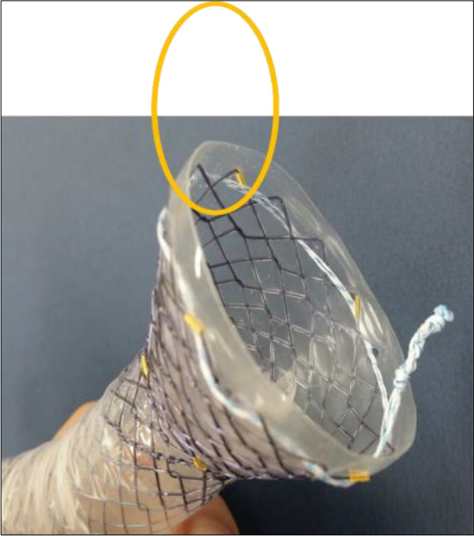 Impact of a new conceptualized anti-reflux Trumpet stent on the quality of life of patients with advanced carcinoma of the cardio-oesophageal junction.