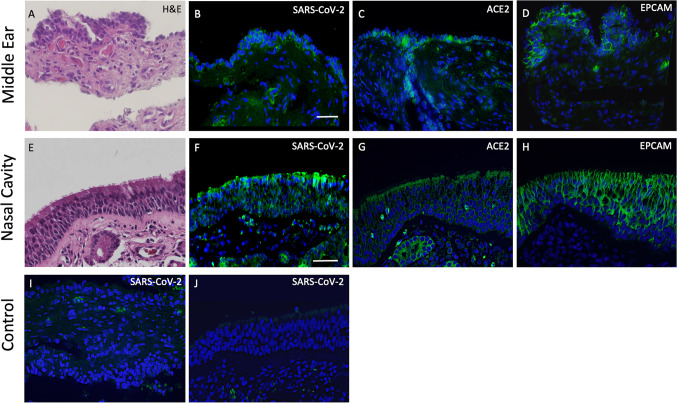 Immunohistochemical and qPCR Detection of SARS-CoV-2 in the Human Middle Ear Versus the Nasal Cavity: Case Series.