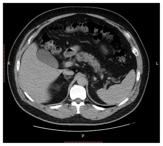 Thiazide-Induced Pancreatitis.