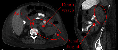 Orthotopic Kidney Transplant as a Fifth Intra-Abdominal Organ after Two Previous Kidney and Two Previous Pancreas Transplants.