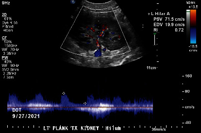Orthotopic Kidney Transplant as a Fifth Intra-Abdominal Organ after Two Previous Kidney and Two Previous Pancreas Transplants.