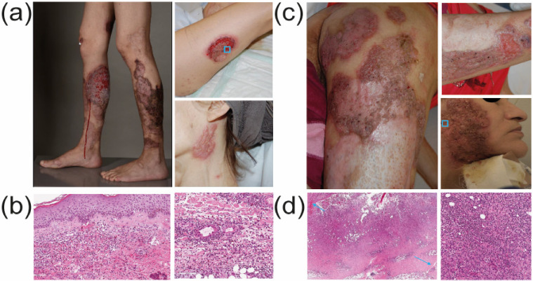 Cocaine/Levamisole-Induced, Skin-Limited ANCA-Associated Vasculitis with Pyoderma Gangrenosum-like Presentation.