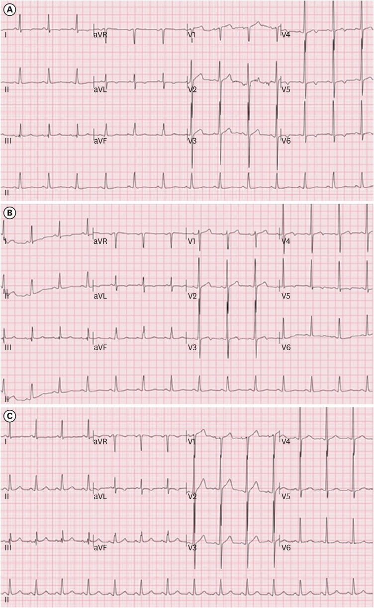 Electrocardiogram abnormalities in antimony exposed workers in the automotive brake lining manufacturing industry: a case report.