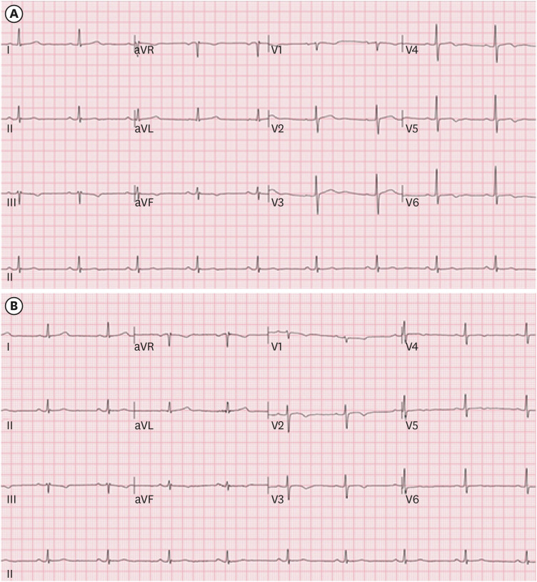 Electrocardiogram abnormalities in antimony exposed workers in the automotive brake lining manufacturing industry: a case report.